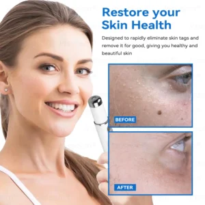 𝐉𝐚𝐬𝐬𝐞𝐞𝐦® 𝐍𝐨𝐧-𝐈𝐧𝐯𝐚𝐬𝐢𝐯𝐞 𝐌𝐨𝐥𝐞 & 𝐖𝐚𝐫𝐭 𝐋𝐚𝐬𝐞𝐫 𝐑𝐞𝐦𝐨𝐯𝐚𝐥 𝐏𝐞𝐧