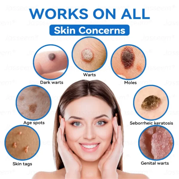 𝐉𝐚𝐬𝐬𝐞𝐞𝐦® 𝐍𝐨𝐧-𝐈𝐧𝐯𝐚𝐬𝐢𝐯𝐞 𝐌𝐨𝐥𝐞 & 𝐖𝐚𝐫𝐭 𝐋𝐚𝐬𝐞𝐫 𝐑𝐞𝐦𝐨𝐯𝐚𝐥 𝐏𝐞𝐧