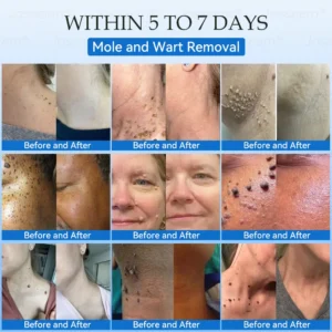 𝐉𝐚𝐬𝐬𝐞𝐞𝐦® 𝐍𝐨𝐧-𝐈𝐧𝐯𝐚𝐬𝐢𝐯𝐞 𝐌𝐨𝐥𝐞 & 𝐖𝐚𝐫𝐭 𝐋𝐚𝐬𝐞𝐫 𝐑𝐞𝐦𝐨𝐯𝐚𝐥 𝐏𝐞𝐧