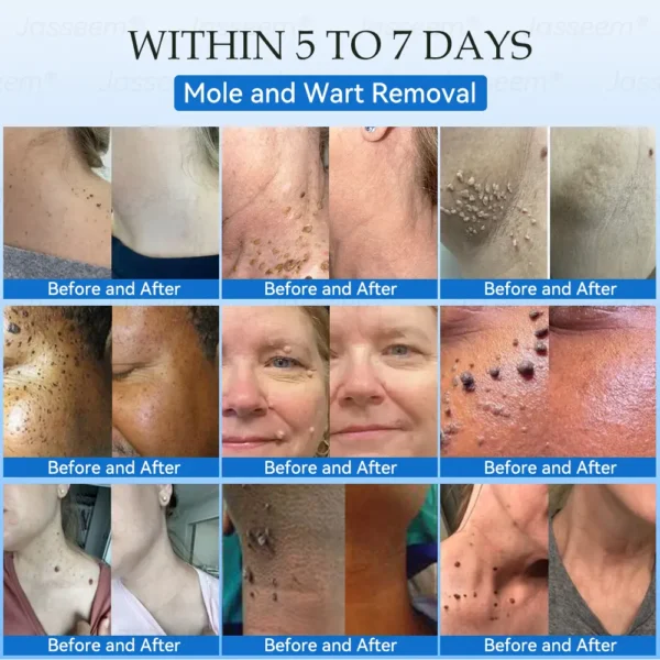 𝐉𝐚𝐬𝐬𝐞𝐞𝐦® 𝐍𝐨𝐧-𝐈𝐧𝐯𝐚𝐬𝐢𝐯𝐞 𝐌𝐨𝐥𝐞 & 𝐖𝐚𝐫𝐭 𝐋𝐚𝐬𝐞𝐫 𝐑𝐞𝐦𝐨𝐯𝐚𝐥 𝐏𝐞𝐧