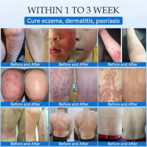 𝐉𝐚𝐬𝐬𝐞𝐞𝐦® 𝐍𝐨𝐧-𝐈𝐧𝐯𝐚𝐬𝐢𝐯𝐞 𝐌𝐨𝐥𝐞 & 𝐖𝐚𝐫𝐭 𝐋𝐚𝐬𝐞𝐫 𝐑𝐞𝐦𝐨𝐯𝐚𝐥 𝐏𝐞𝐧