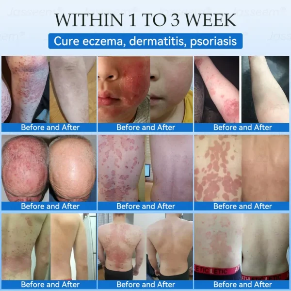 𝐉𝐚𝐬𝐬𝐞𝐞𝐦® 𝐍𝐨𝐧-𝐈𝐧𝐯𝐚𝐬𝐢𝐯𝐞 𝐌𝐨𝐥𝐞 & 𝐖𝐚𝐫𝐭 𝐋𝐚𝐬𝐞𝐫 𝐑𝐞𝐦𝐨𝐯𝐚𝐥 𝐏𝐞𝐧