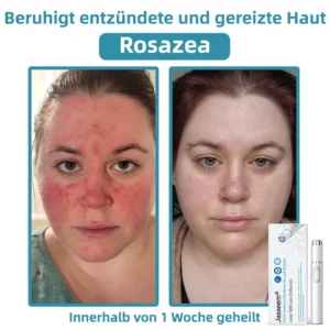 𝐉𝐚𝐬𝐬𝐞𝐞𝐦® 𝐍𝐢𝐜𝐡𝐭-𝐢𝐧𝐯𝐚𝐬𝐢𝐯 𝐋𝐞𝐛𝐞𝐫𝐟𝐥𝐞𝐜𝐤- 𝐮𝐧𝐝 𝐖𝐚𝐫𝐳𝐞𝐧𝐞𝐧𝐭𝐟𝐞𝐫𝐧𝐮𝐧𝐠𝐬-𝐋𝐚𝐬𝐞𝐫𝐬𝐭𝐢𝐟𝐭