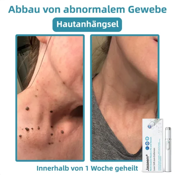 𝐉𝐚𝐬𝐬𝐞𝐞𝐦® 𝐍𝐢𝐜𝐡𝐭-𝐢𝐧𝐯𝐚𝐬𝐢𝐯 𝐋𝐞𝐛𝐞𝐫𝐟𝐥𝐞𝐜𝐤- 𝐮𝐧𝐝 𝐖𝐚𝐫𝐳𝐞𝐧𝐞𝐧𝐭𝐟𝐞𝐫𝐧𝐮𝐧𝐠𝐬-𝐋𝐚𝐬𝐞𝐫𝐬𝐭𝐢𝐟𝐭