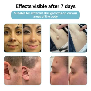 𝐉𝐚𝐬𝐬𝐞𝐞𝐦® Medical-Grade Laser Pen
