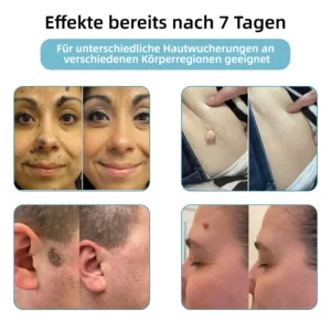 𝐉𝐚𝐬𝐬𝐞𝐞𝐦® Nicht-invasive Laserstift zur Entfernung von Hautflecken und Warzen