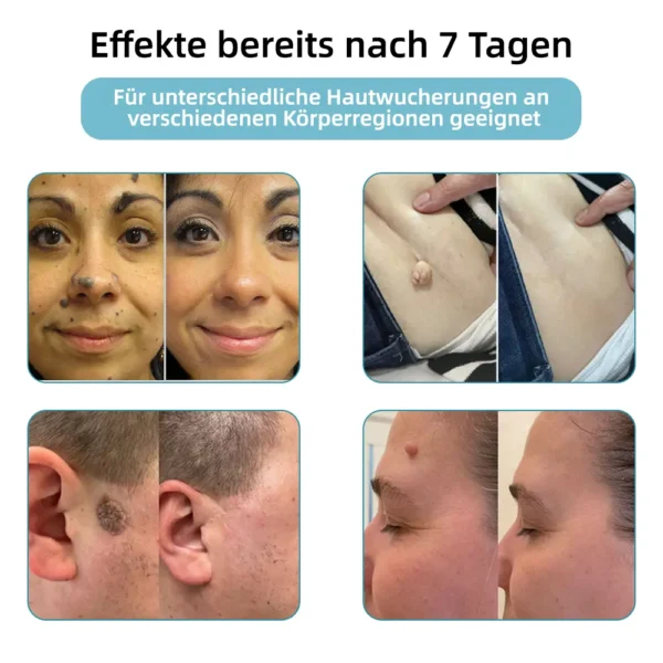 𝐉𝐚𝐬𝐬𝐞𝐞𝐦® Nicht-invasive Laserstift zur Entfernung von Hautflecken und Warzen