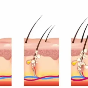 🎄🎁(Christmas Sale – Huge Discounts!)LOVILDS™ Rosemary Hair Growth Essence 100% Natural Hair Growth🌱