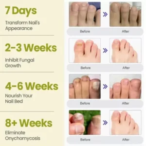 Cvreoz® Nail Fungal Patches Pro+