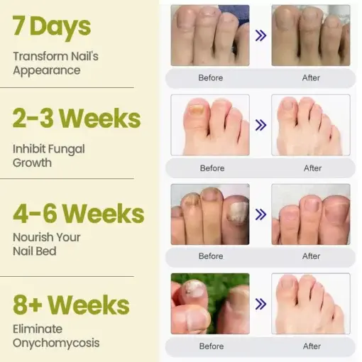 Cvreoz® Nail Fungal Patches Pro+