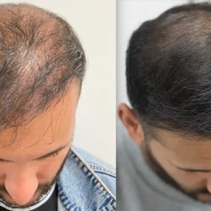 Lovilds® Hair Restoration Spray ( Reawaken Your Roots. Regrow Naturally. ✨ Clinically Proven Hair Regrowth Within 4 Weeks ✨)