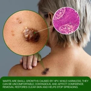 Timilk® ClinixClear Wart Remover Patch