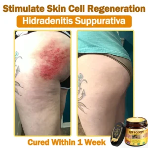 [𝐎𝐟𝐟𝐢𝐜𝐢𝐚𝐥 𝐁𝐫𝐚𝐧𝐝 𝐒𝐭𝐨𝐫𝐞] 🐝 LOVILDS™ 𝐁𝐞𝐞 Poison 𝐀𝐥𝐥-𝐢𝐧-𝐎𝐧𝐞 𝐂𝐫𝐞𝐚𝐦 (👩‍⚕️ 𝐀𝐦𝐞𝐫𝐢𝐜𝐚𝐧 𝐀𝐜𝐚𝐝𝐞𝐦𝐲 𝐨𝐟 𝐃𝐞𝐫𝐦𝐚𝐭𝐨𝐥𝐨𝐠𝐲 𝟐𝟎𝟐𝟓 𝐒𝐩𝐞𝐜𝐢𝐚𝐥𝐥𝐲 𝐑𝐞𝐜𝐨𝐦𝐦𝐞𝐧𝐝𝐞𝐝 𝐏𝐫𝐨𝐝𝐮𝐜𝐭)