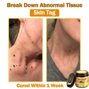 [𝐎𝐟𝐟𝐢𝐜𝐢𝐚𝐥 𝐁𝐫𝐚𝐧𝐝 𝐒𝐭𝐨𝐫𝐞] 🐝 LOVILDS™ 𝐁𝐞𝐞 Poison 𝐀𝐥𝐥-𝐢𝐧-𝐎𝐧𝐞 𝐂𝐫𝐞𝐚𝐦 (👩‍⚕️ 𝐀𝐦𝐞𝐫𝐢𝐜𝐚𝐧 𝐀𝐜𝐚𝐝𝐞𝐦𝐲 𝐨𝐟 𝐃𝐞𝐫𝐦𝐚𝐭𝐨𝐥𝐨𝐠𝐲 𝟐𝟎𝟐𝟓 𝐒𝐩𝐞𝐜𝐢𝐚𝐥𝐥𝐲 𝐑𝐞𝐜𝐨𝐦𝐦𝐞𝐧𝐝𝐞𝐝 𝐏𝐫𝐨𝐝𝐮𝐜𝐭)