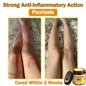 [𝐎𝐟𝐟𝐢𝐜𝐢𝐚𝐥 𝐁𝐫𝐚𝐧𝐝 𝐒𝐭𝐨𝐫𝐞] 🐝 LOVILDS™ 𝐁𝐞𝐞 Poison 𝐀𝐥𝐥-𝐢𝐧-𝐎𝐧𝐞 𝐂𝐫𝐞𝐚𝐦 (👩‍⚕️ 𝐀𝐦𝐞𝐫𝐢𝐜𝐚𝐧 𝐀𝐜𝐚𝐝𝐞𝐦𝐲 𝐨𝐟 𝐃𝐞𝐫𝐦𝐚𝐭𝐨𝐥𝐨𝐠𝐲 𝟐𝟎𝟐𝟓 𝐒𝐩𝐞𝐜𝐢𝐚𝐥𝐥𝐲 𝐑𝐞𝐜𝐨𝐦𝐦𝐞𝐧𝐝𝐞𝐝 𝐏𝐫𝐨𝐝𝐮𝐜𝐭)