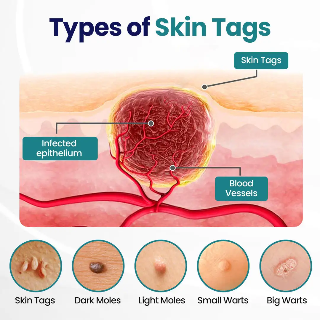 Timilk® WartLift Corn Removal Liquid (new)