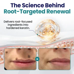 Timilk® WartLift Corn Removal Liquid (new)