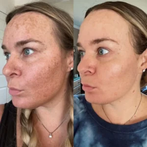 LOVILDS™ Facial Cream with 7% Arbutin + 4% Tranexamic Acid