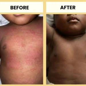 LOVILDS® Honey Eczema Cream