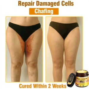 𝐋𝐎𝐕𝐈𝐋𝐃𝐒™ 𝐁𝐞𝐞 𝐏𝐨𝐢𝐬𝐨𝐧 𝐀𝐥𝐥-𝐢𝐧-𝐎𝐧𝐞 𝐂𝐫𝐞𝐚𝐦–🌸 Anti-aging,Hydrating, Skin Repair, Even Tone, Acne and Dark Spot Treatment, Wart and Mole Removal, Psoriasis Relief