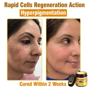 𝐋𝐎𝐕𝐈𝐋𝐃𝐒™ 𝐁𝐞𝐞 𝐏𝐨𝐢𝐬𝐨𝐧 𝐀𝐥𝐥-𝐢𝐧-𝐎𝐧𝐞 𝐂𝐫𝐞𝐚𝐦–🌸 Anti-aging,Hydrating, Skin Repair, Even Tone, Acne and Dark Spot Treatment, Wart and Mole Removal, Psoriasis Relief
