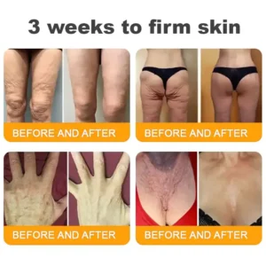 𝐋𝐎𝐕𝐈𝐋𝐃𝐒™ 𝐁𝐞𝐞 𝐏𝐨𝐢𝐬𝐨𝐧 𝐀𝐥𝐥-𝐢𝐧-𝐎𝐧𝐞 𝐂𝐫𝐞𝐚𝐦–🌸 Anti-aging,Hydrating, Skin Repair, Even Tone, Acne and Dark Spot Treatment, Wart and Mole Removal, Psoriasis Relief