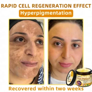 LOVILDS™ 🐝Bee Poison Skin Restoration Cream 🐝