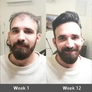 LOVILDS® Highly Effective Biotin & Rosemary Hair Growth Serum