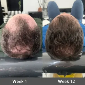 LOVILDS® Highly Effective Biotin & Rosemary Hair Growth Serum