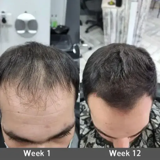 LOVILDS® Highly Effective Biotin & Rosemary Hair Growth Serum