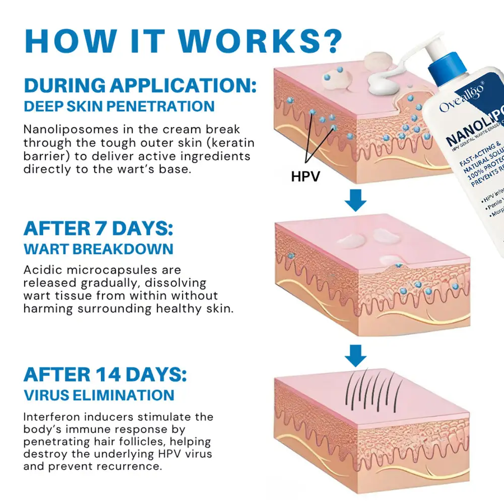 Oveallgo® NanoLipo HPV Genital Warts Eraser Cream ProX